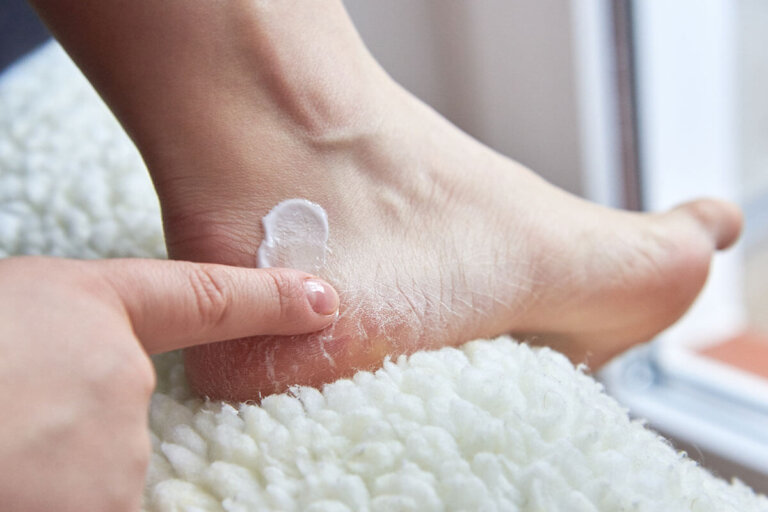 athlete's foot cream